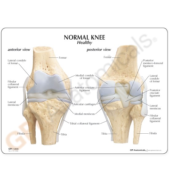 GPI Anatomicals Knee Joint Model With Meniscus Tears, LFA #1010, Orthopedic Doctor/Patient Education Tool