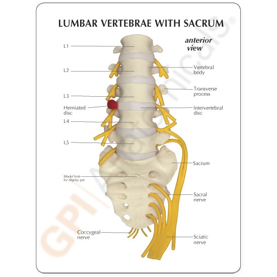 Spine Anatomical Model 5 pc Vertebrae w Sacrum Herniated Disc