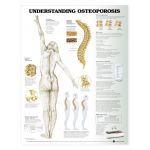 Osteoporosis Chart - Understanding Osteoporosis