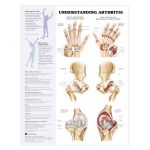 Arthritis Chart - Understanding Arthritis