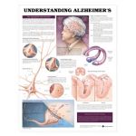 Alzheimers  - Understanding Alzheimers Disease