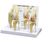 Canine Knee 4-stage Osteoarthritis Anatomical Model Set