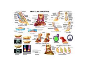 Equine Chart - Horse Navicular Syndrome Wall Chart