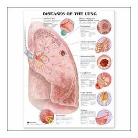 Lung Chart - Diseases of the Lung Lung Chart - Diseases of the Lung