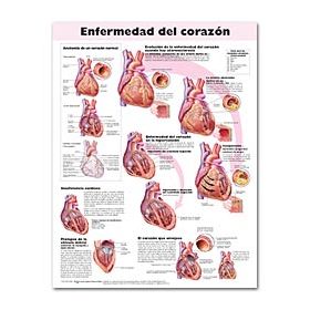 Heart Disease Chart - Heart Disease Spanish Language Heart Disease Chart - Heart Disease Spanish Language
