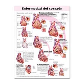 Heart Disease Chart - Heart Disease Spanish Language