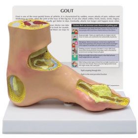 Foot Gout Anatomical Model