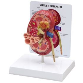 Kidney Diseased Anatomical Model