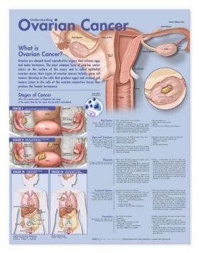 Cancer Chart - Understanding Ovarian Cancer