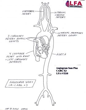 Angiogram Sam Plus IM CABG X3 with three Coronary Artery Bypass Grafts. Anatomical Training Model, Cyroacrylic