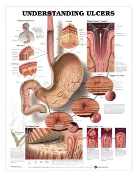 Ulcers Chart - Understanding Ulcers