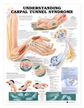 Carpal Tunnel Chart - Understanding Carpal Tunnel Syndrome
