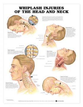 Whiplash Chart - Whiplash Injuries of the Head and Neck