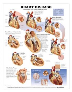 Heart Disease Chart - Heart Disease