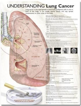 Lung Cancer Chart - Understanding Lung Cancer