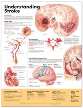 Stroke Chart - Understanding Stroke