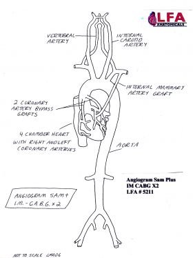 Angiogram Sam Plus IM CABG X2 with two Coronary Artery Bypass Grafts. Anatomical Training Model, Cyroacrylic
