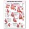 Heart Disease Chart - Heart Disease Spanish Language